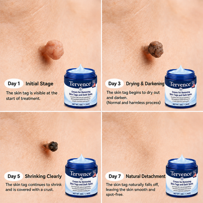 Tervence® Advanced Correcting Cream for Skin Tags, Moles & Spots – 7‑Day Painless & Scar‑Free – Advanced Care for Skin Imperfections